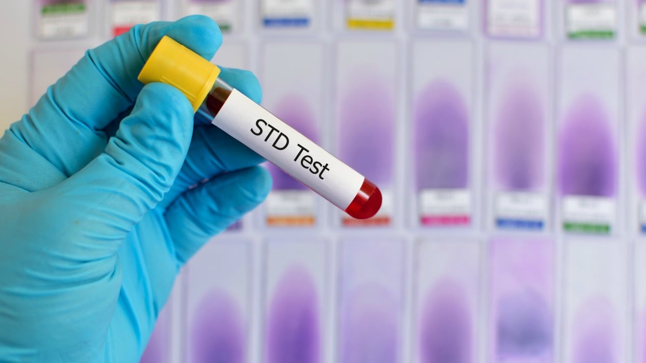 Ne kadar zamanda bir STD testi yaptırmalısınız?