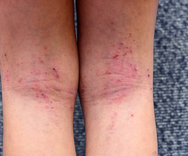 Egzama nedir, neden olur ve egzama nasıl geçer? | Uplifers