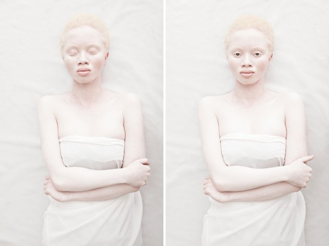 albino kadın