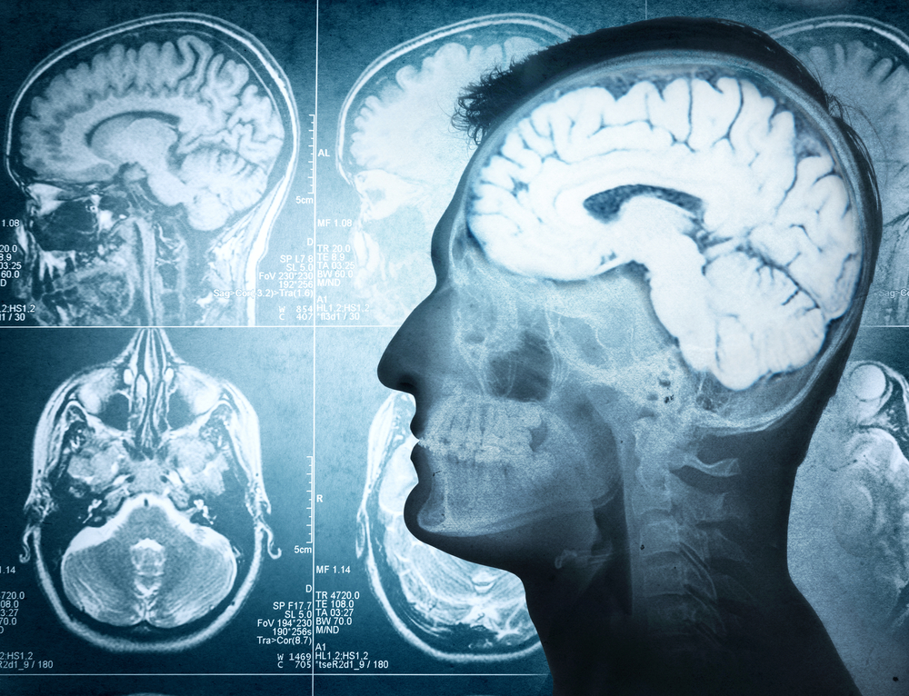 Beyin proteziyle hafıza kaybını aşmak artık mümkün olabilecek